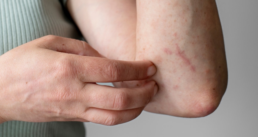 Aтопический дерматит или воспаление кожи