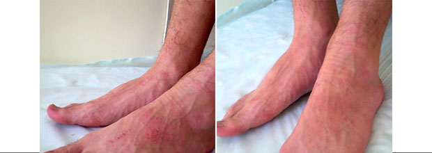 атопический дерматит на ногах