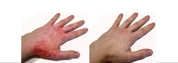 дисгидротическая экзема кистей рук лечение