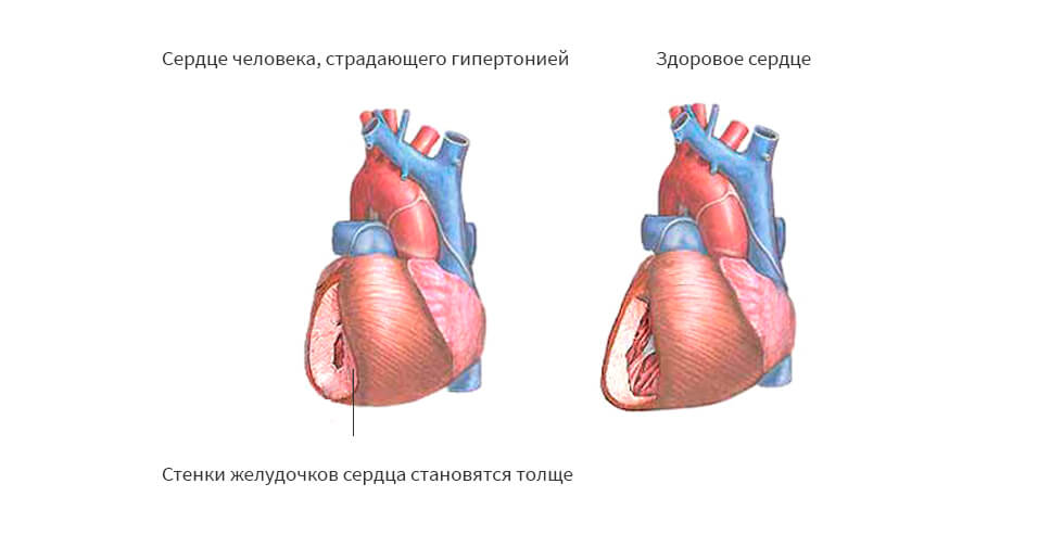 гипертония артериальная